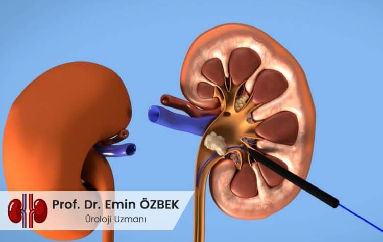 kapali bobrek tasi tedavisi perkutan